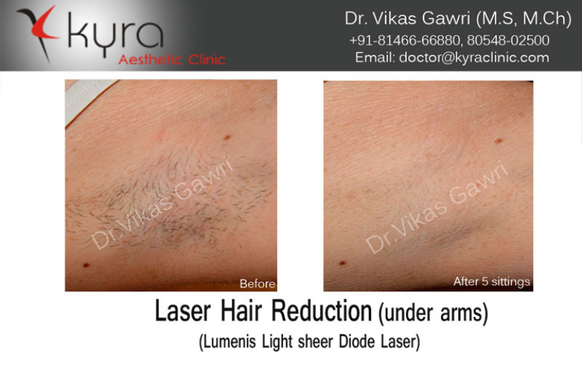 Laser Hair Removal Ludhiana